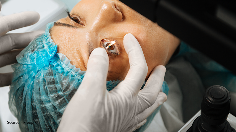 Close-up of a patient undergoing laser eye surgery (LASIK) with a specialised surgical machine to reshape the cornea and permanently correct severe astigmatism.