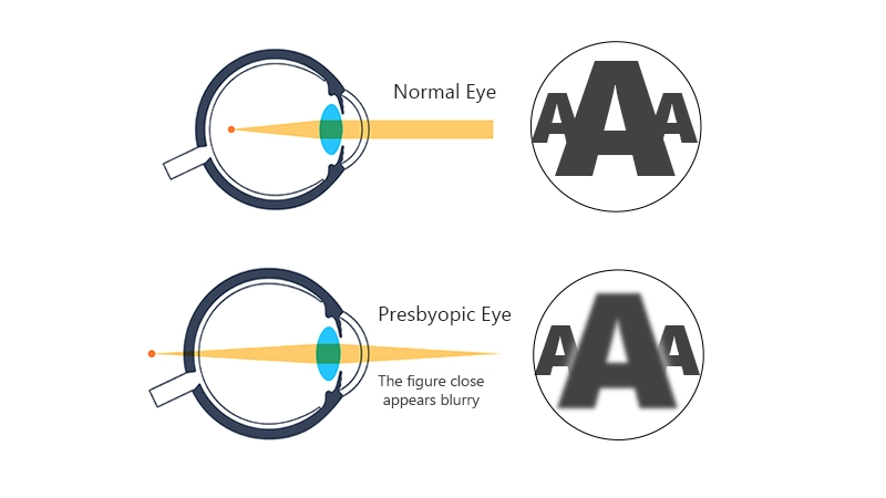 What is Presbyopia?