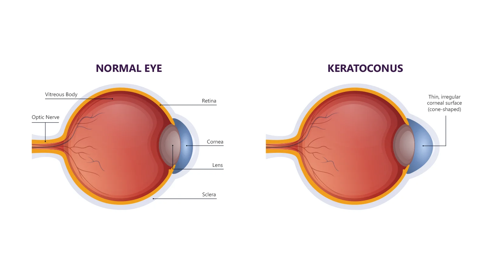 Why Is Rubbing Your Eyes Bad