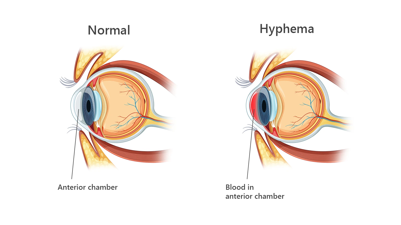 What are the Symptoms of Hyphema