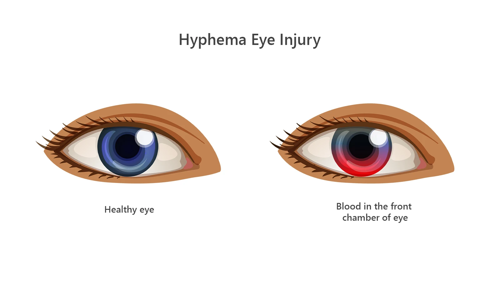 What are the Causes of Hyphema