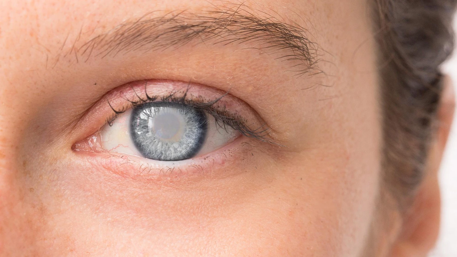 What are the Complications of Hyphema
