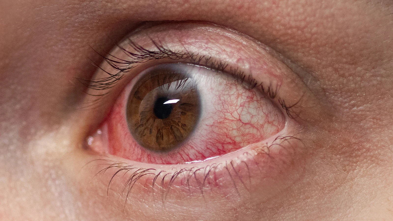 Macro photograph of a brown eye with severe redness and visible blood vessels in the whites.
