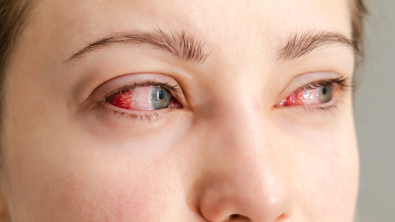 Close-up of a person with light eyes showing severe redness and bloodshot veins in the whites of both eyes.