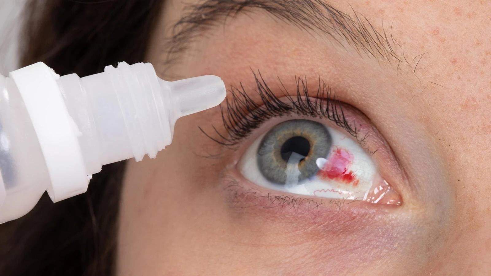 Close-up of an eye with a bright red blood patch on the white and an eye drop bottle held near it.