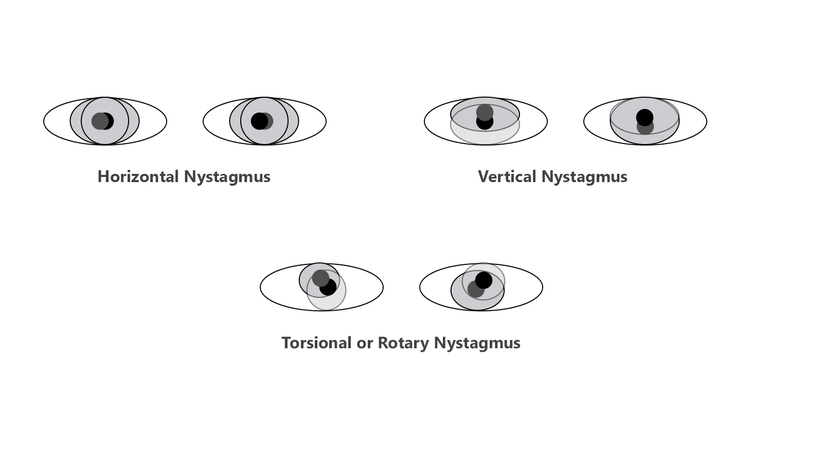 Diagram labelling and showing Horizontal, Vertical, and Torsional or Rotary Nystagmus eye movement patterns.
