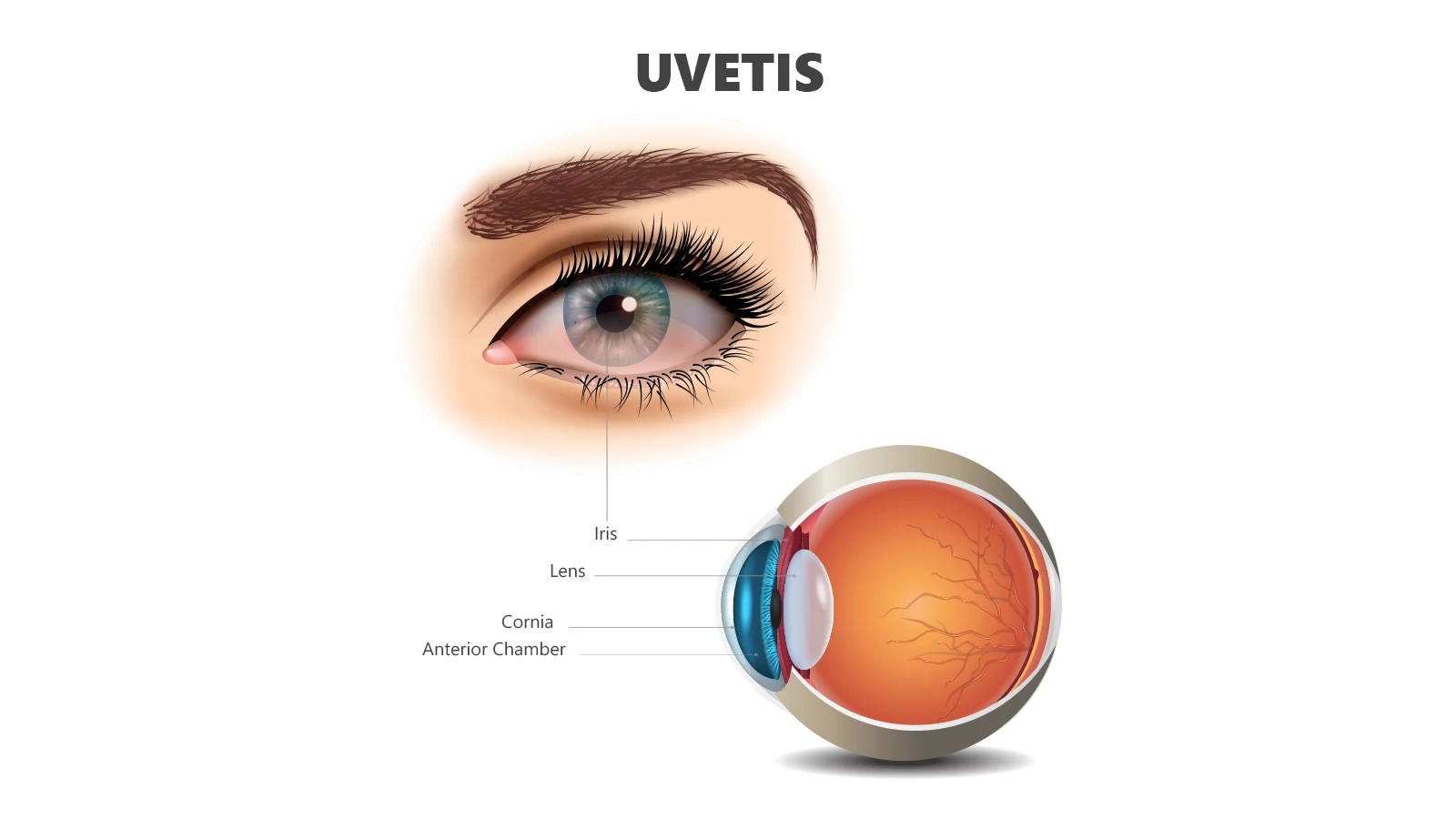 Medical diagram of Uveitis featuring a red eye illustration and a labelled cross-section of eye anatomy.