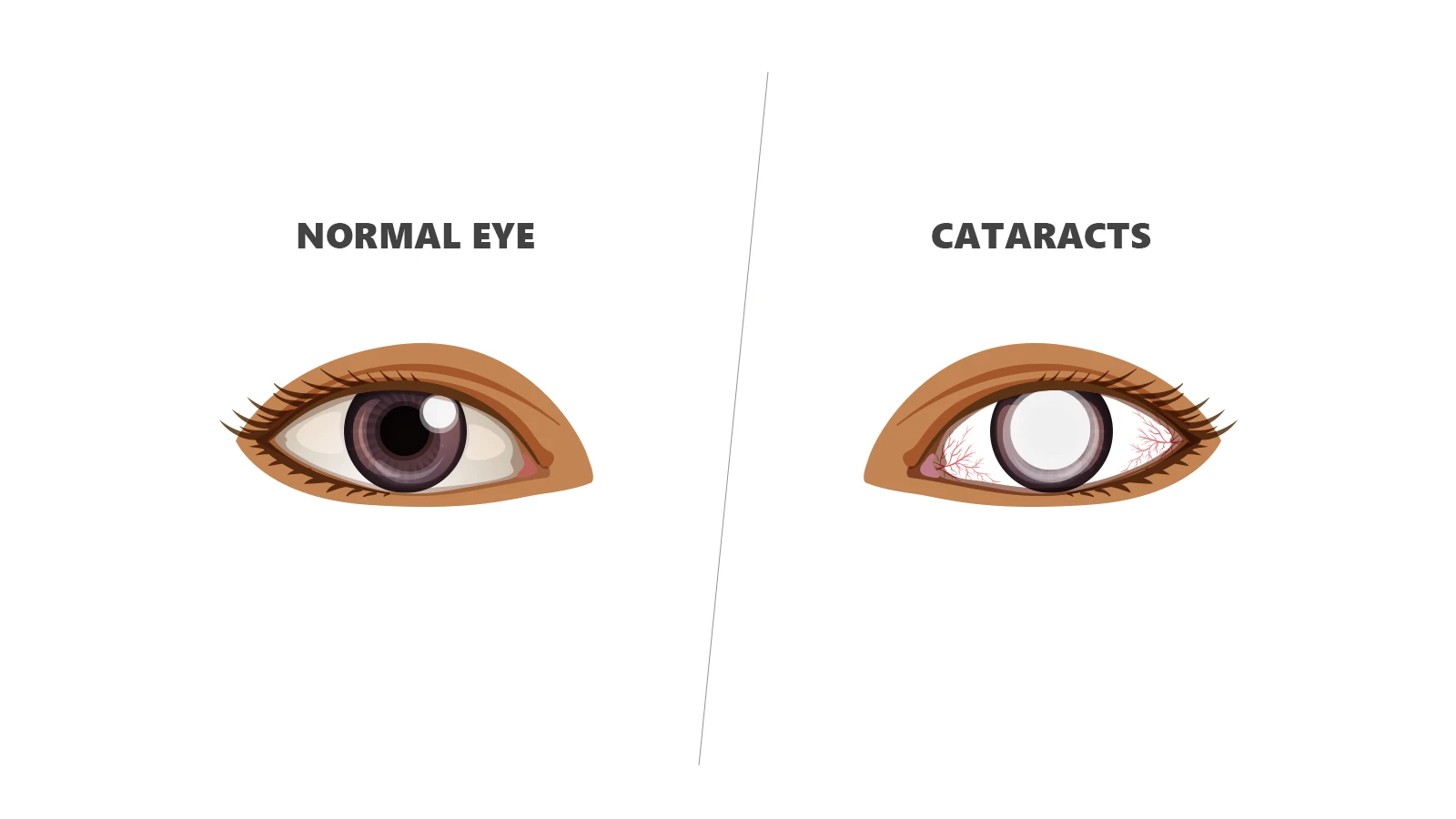 Side-by-side illustration of a normal brown eye vs. a cataract eye with a cloudy, opaque white pupil and red veins.