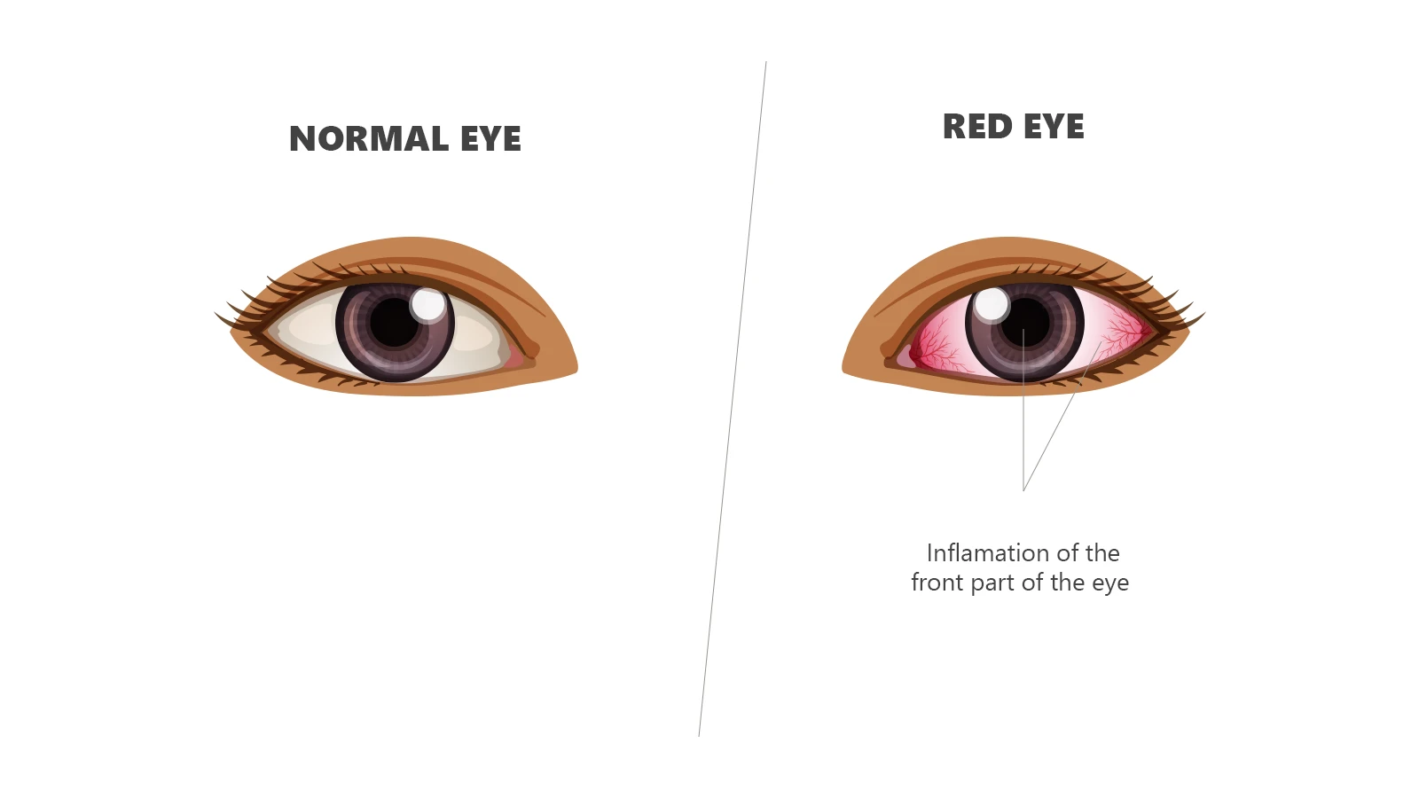 Illustration comparing a "Normal Eye" to a "Red Eye" with inflammation of the front part shown in the diagram.