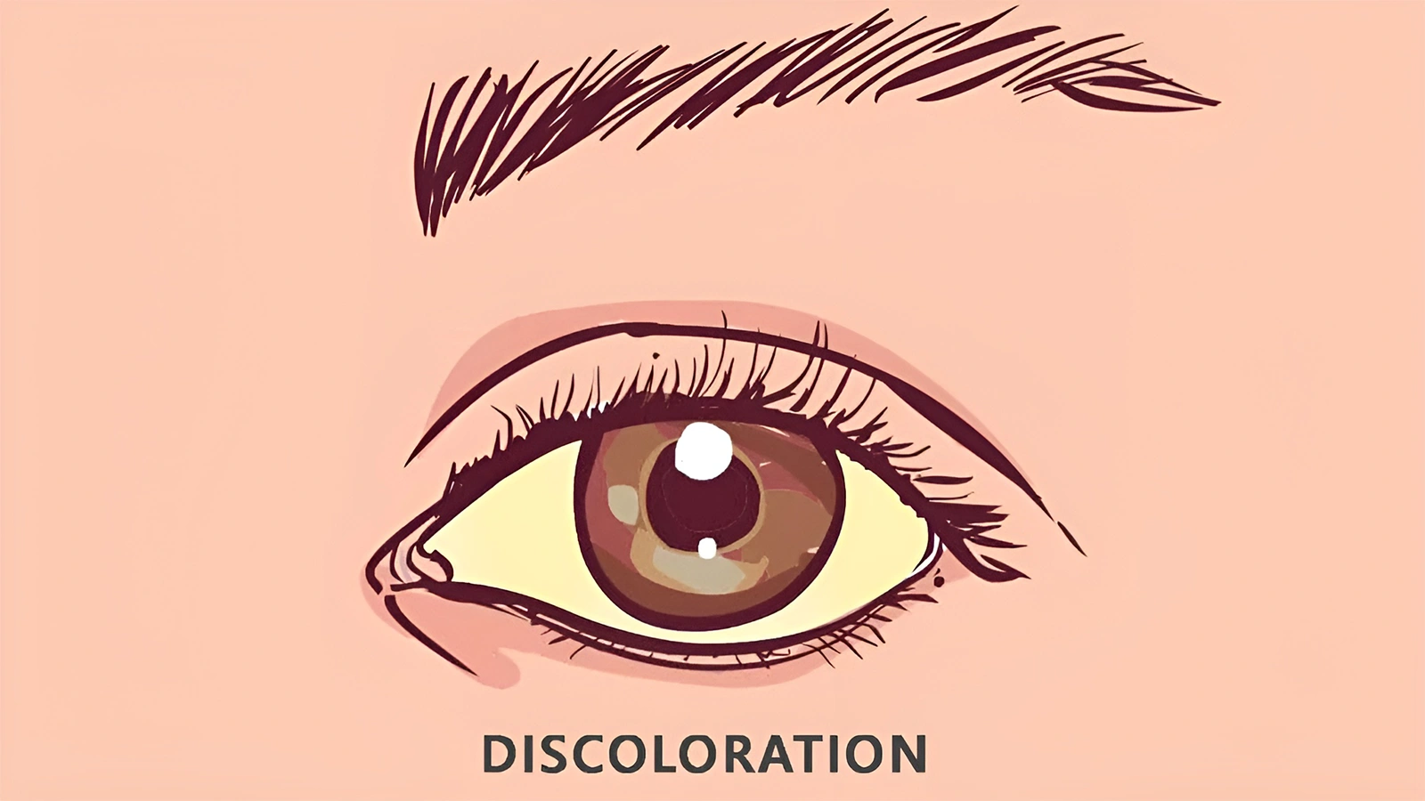 Medical illustration of a single eye with dark, purple-bruised skin under the lower eyelid, clearly labeled with the word "Discoloration."